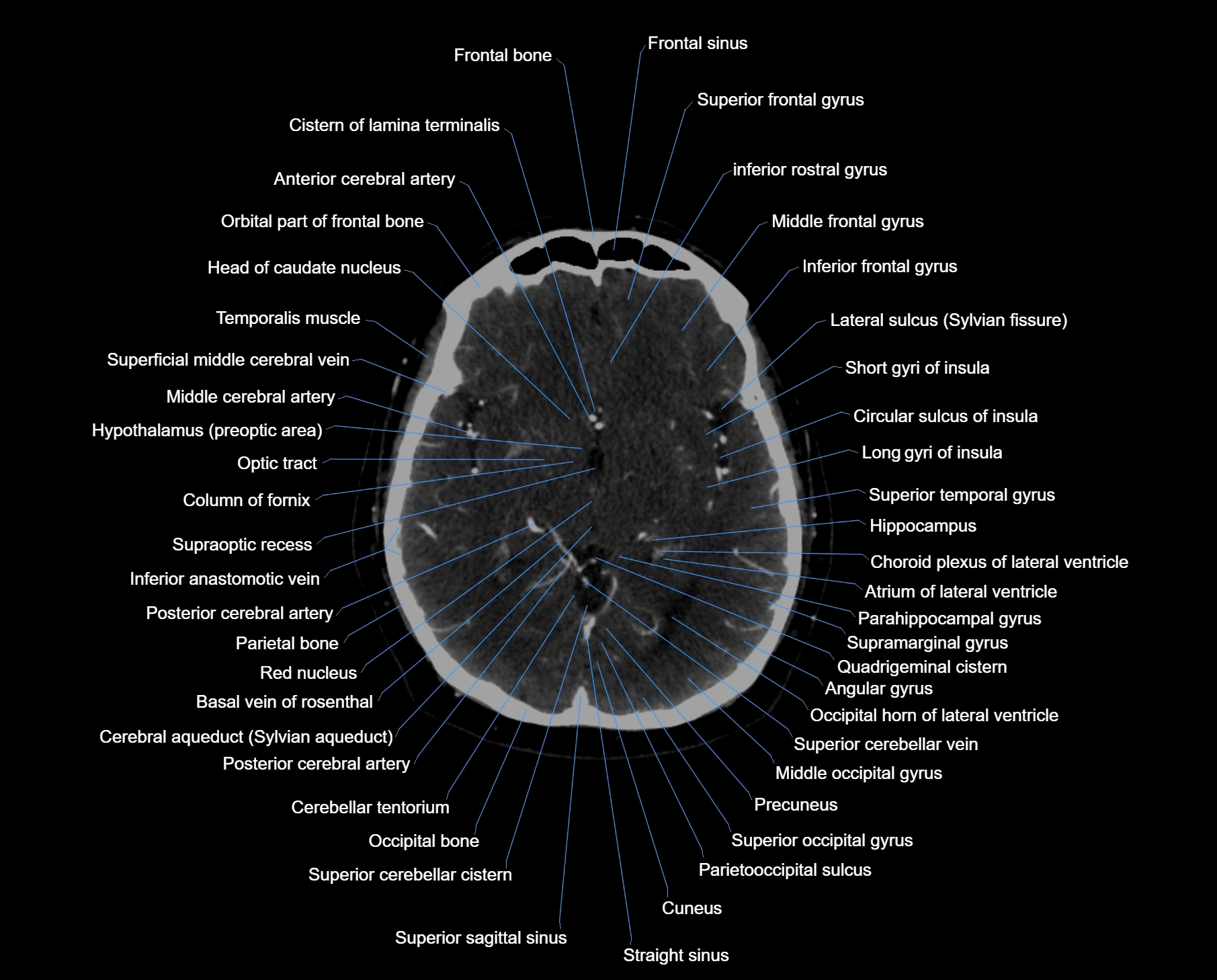 CT scan brain axial labelled cross sectional anatomy image-img-000032.webp